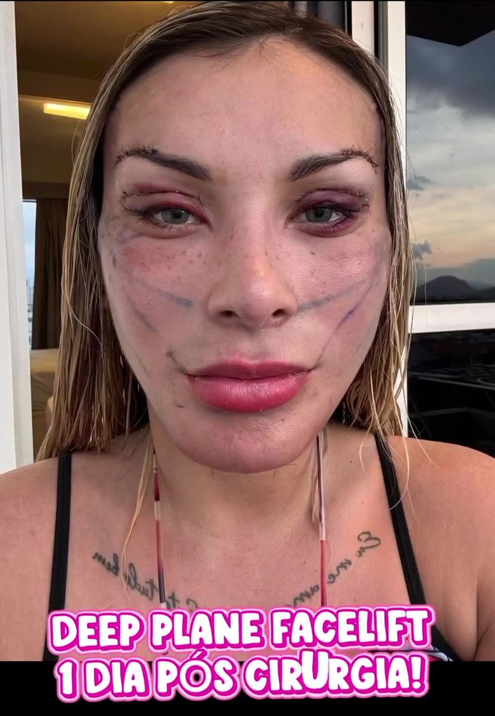 Andressa Urach mostra rosto ap&oacute;s facelift profundo para 'ter rosto de 23 anos' &mdash; Foto: Reprodu&ccedil;&atilde;o/Instagram