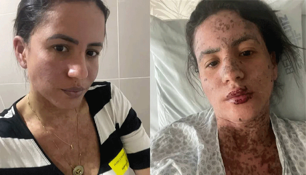 Já recuperada, Carol Santos mostrou como ficou sua pele por causa da Síndrome de Stevens-Johnson — Foto: Reprodução/Instagram