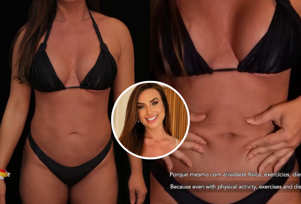 Nicole Bahls impressiona ao mostrar antes e depois de lipo HD; veja fotos — Foto: Reprodução/Instagram