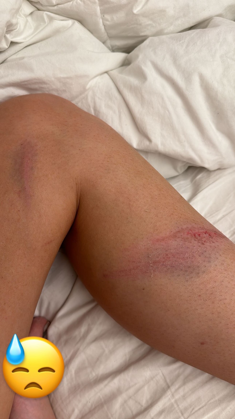 Emily Garcia mostra hematomas após briga por buquê — Foto: Reprodução/Instagram