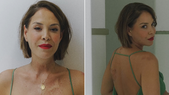 Atriz Júlia Almeida mostra cicatrizes e fala de autoaceitação