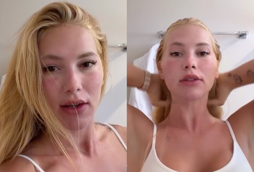 Virginia Fonseca mostra rosto inchado após procedimento e tranquiliza seguidores: 'Tudo certo'
