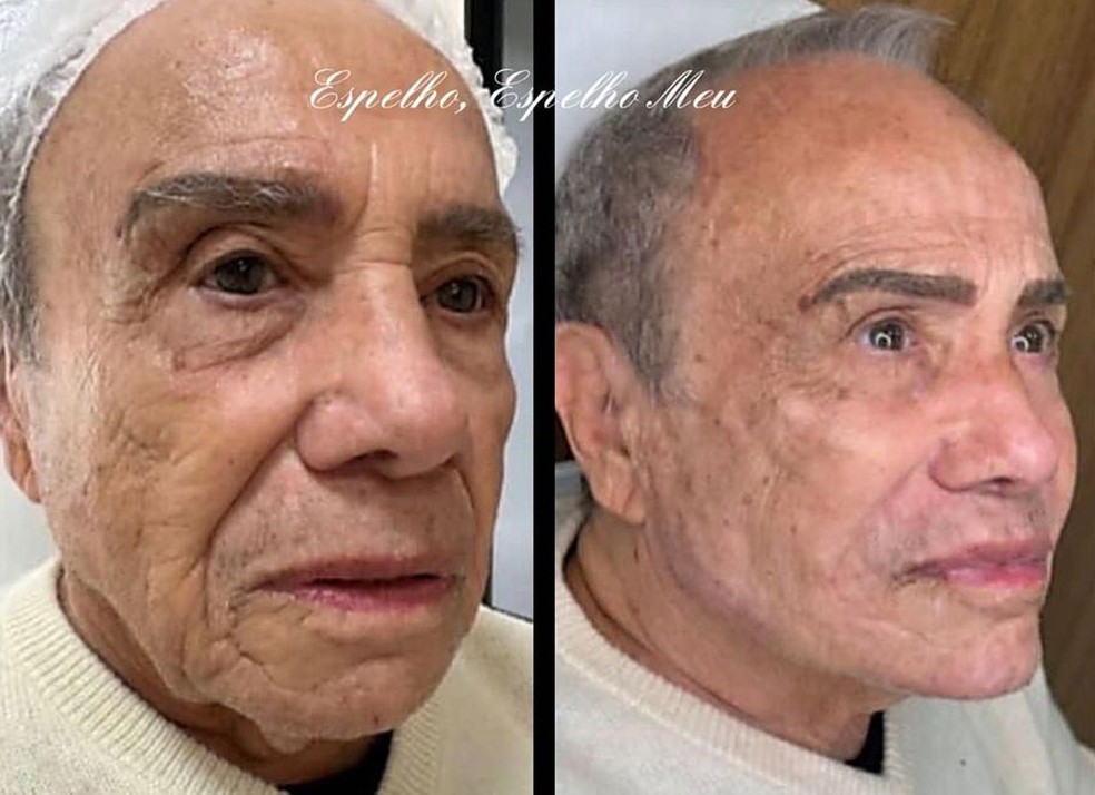 O antes e depois de Stênio Garcia — Foto: Reprodução Instagram