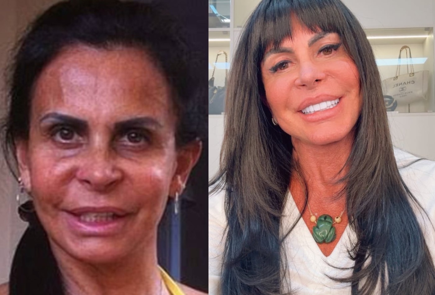 Gretchen diz que já fez 'mais de 100' procedimentos estéticos; veja alguns deles - Foto