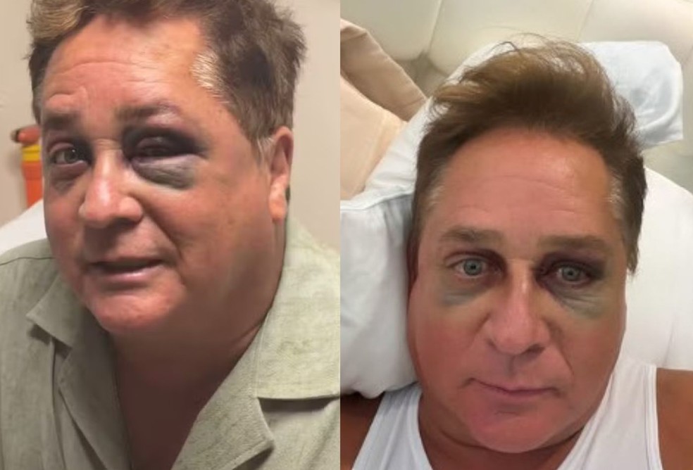 Antes e depois da recuperação de Leonardo — Foto: Reprodução/Instagram