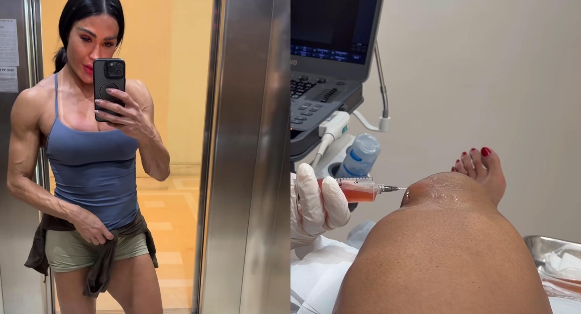 Gracyanne Barbosa faz punção para retirar líquido do joelho por conta do 'Dança dos Famosos': 'Demanda alta''