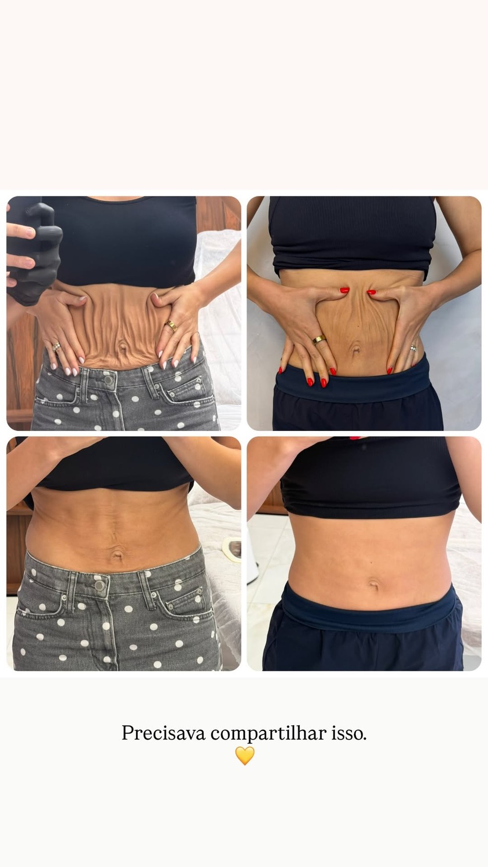 Um mês após reclamar de barriga 'flácida' e 'umbigo caído', Lyandra Costa se surpreende com resultado de procedimento — Foto: Reprodução/Instagram