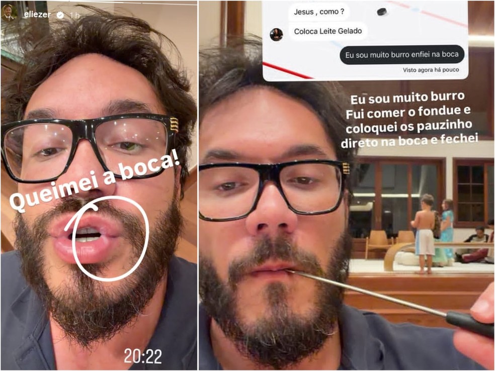 Eliezer sofre queimadura labial — Foto: Reprodução/Instagram