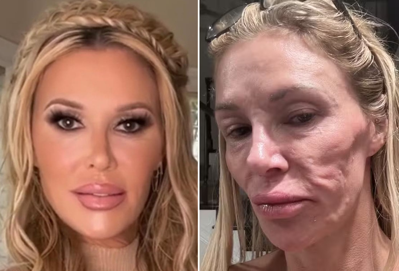 Brandi Glanville fará cirurgia para 'remover o rosto' após 'derretimento'