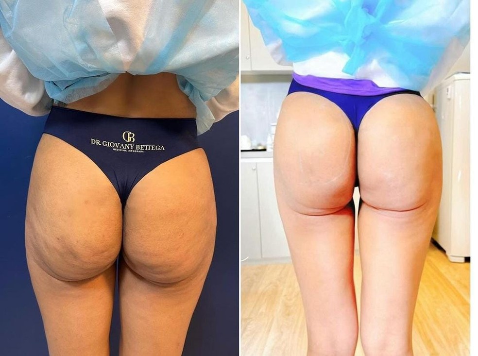 Deolane Bezerra mostra o bumbum após procedimento estético.