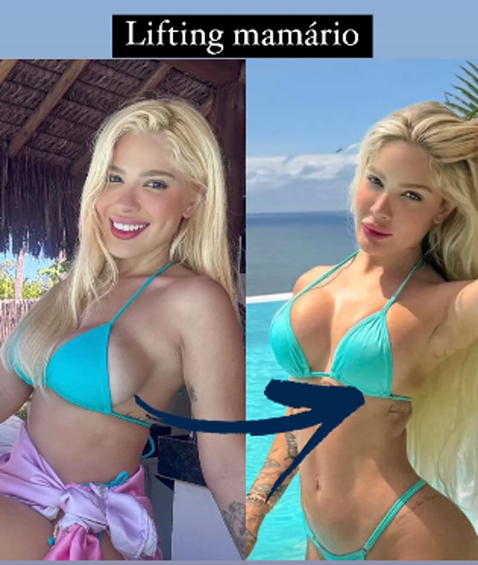 Karoline Lima antes e depois de plsticas nos seios  Foto: Reproduo/Instagram