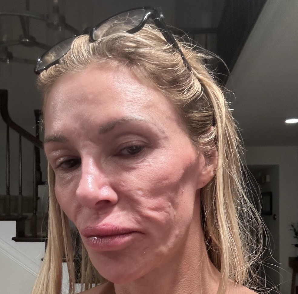 Ex-modelo Brandi Glanville mostra rosto 'derretido' e preocupa fãs — Foto: Reprodução/X