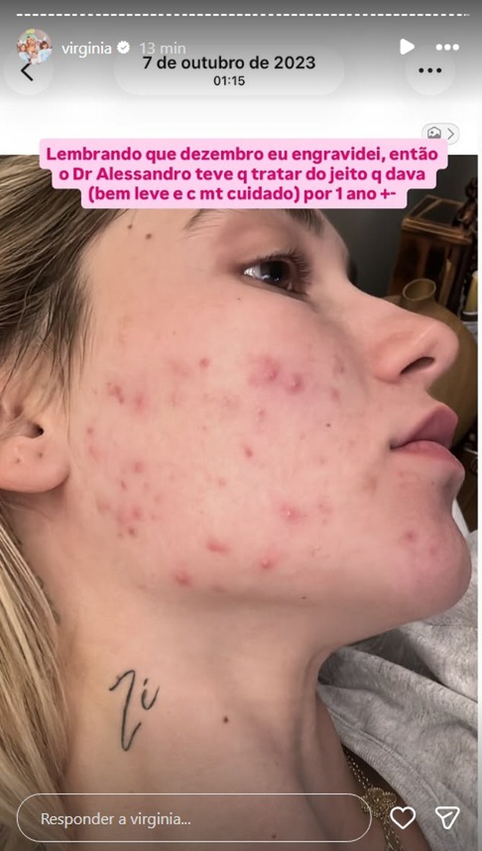 Virginia Fonseca resgata foto de 2023 e expõe problema com acne — Foto: Reprodução/Instagram