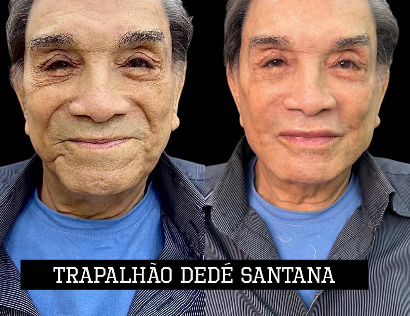 Antes e depois de Dedé Santana — Foto: Reprodução/Instagram