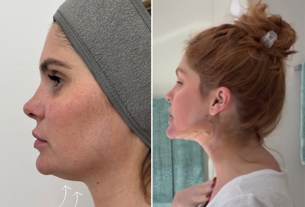 Antes e depois de técnica de Bárbara Evans para diminuir papada — Foto: Reprodução/Instagram