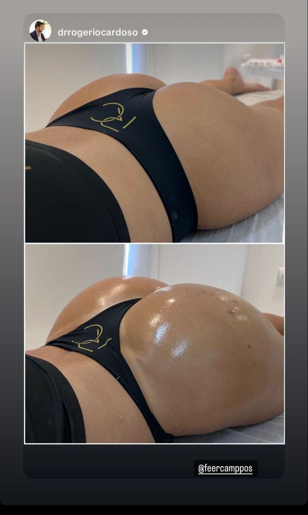 Fernanda Campos faz procedimento para empinar bumbum e cita cuidados: Três  dias sem sexo