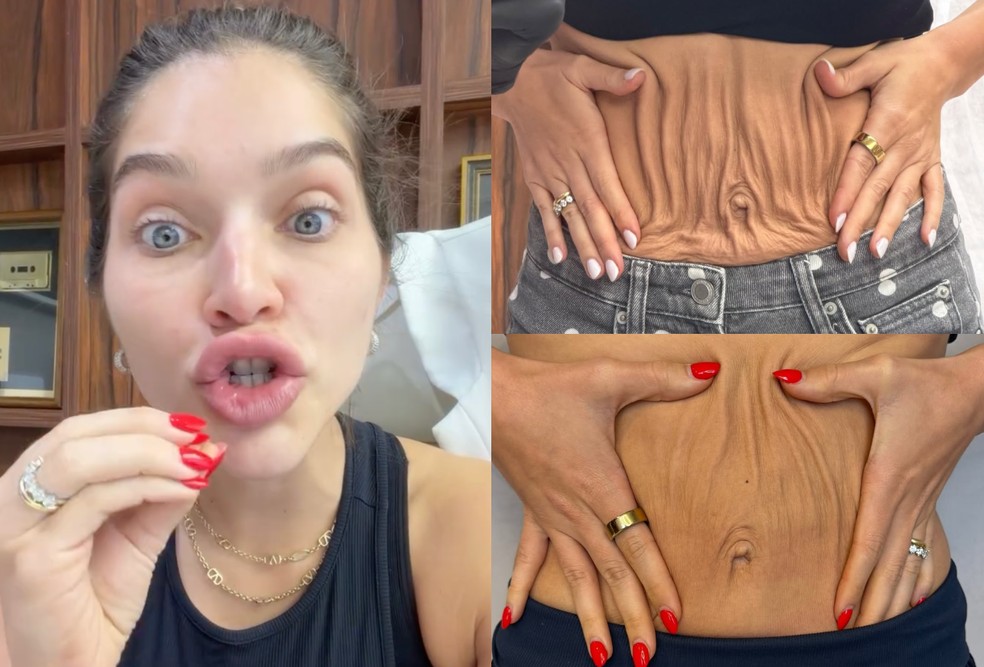Um mês após reclamar de barriga 'flácida' e 'umbigo caído', Lyandra Costa se surpreende com resultado de procedimento — Foto: Reprodução/Instagram