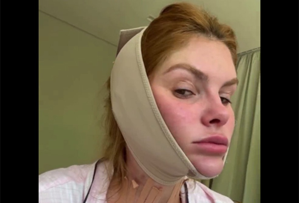 Bárbara Evans recorre a técnica para diminuir papada — Foto: Reprodução/Instagram