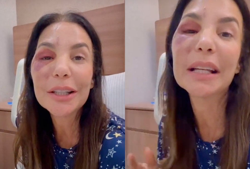 Rosto de Ivete Sangalo após cirurgia — Foto: Reprodução/Instagram