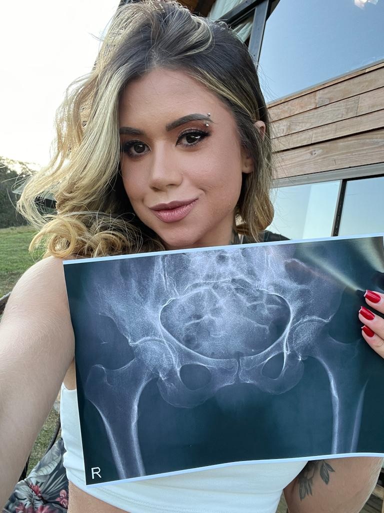 Musa do OnlyFans faz raio-X para provar 'bumbum natural' de 102 cm