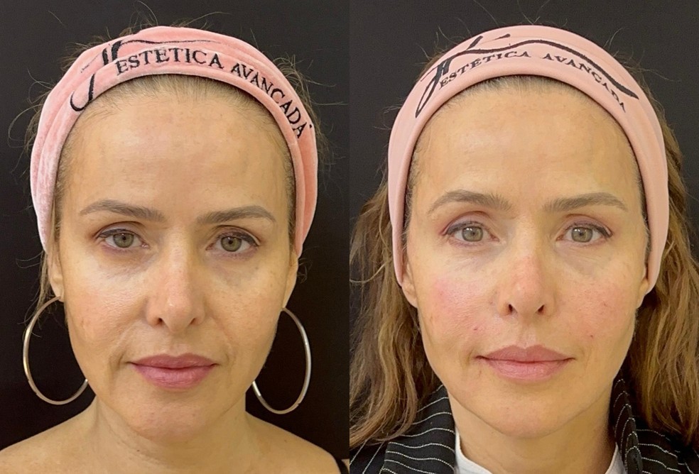 Leona Cavalli passa por procedimento que dá efeito lifting; antes e depois