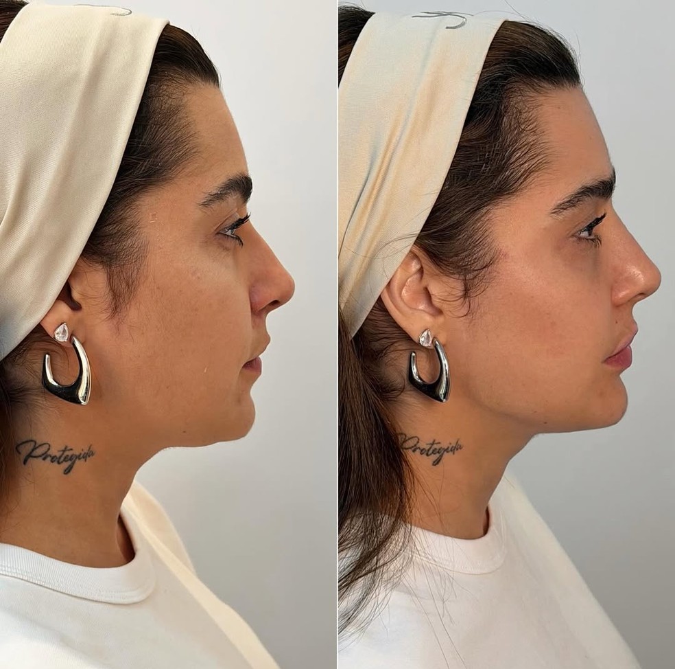 Antes e depois: Lauana Prado passa por harmonização facial — Foto: Reprodução/Instagram