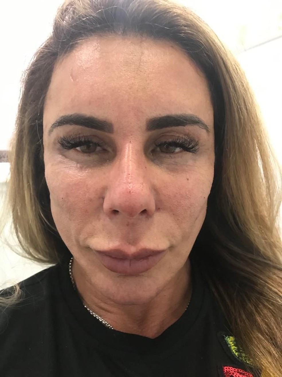 Andrea Sunshine após harmonização facial malsucedida — Foto: Divulgação