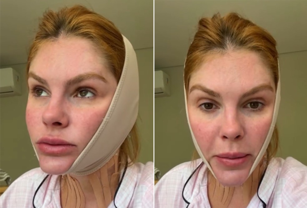Bárbara Evans passa por cirurgia plástica para remover papada — Foto: Reprodução/Instagram